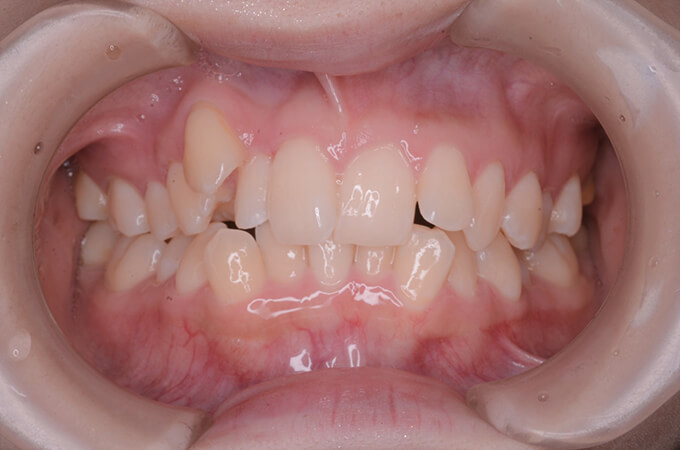 田中矯正歯科医院の症例実績1